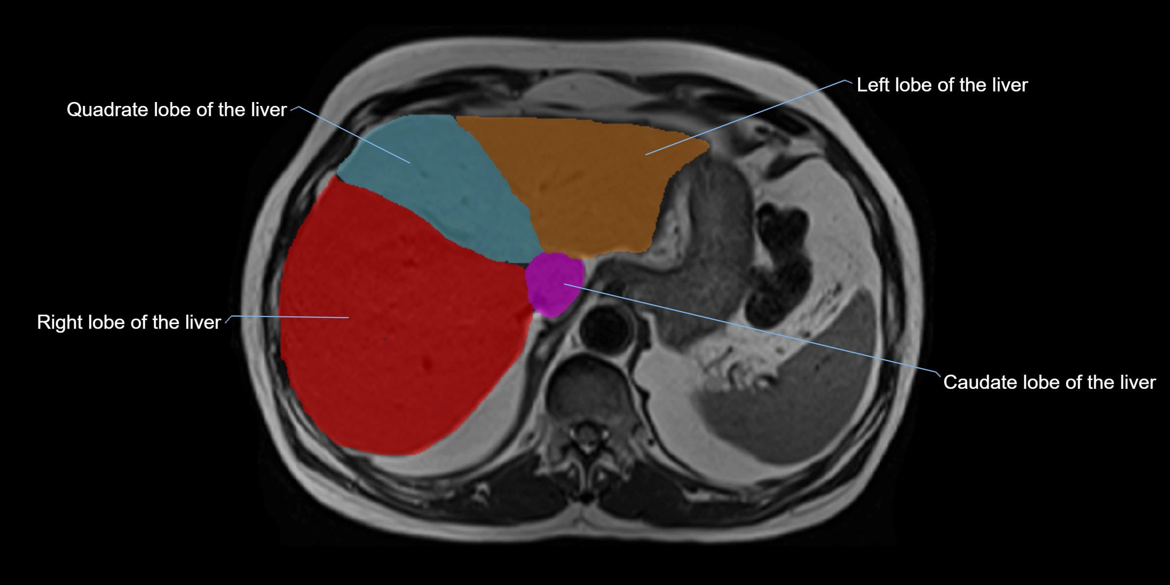 MRI liver lobe axial cross sectional 3T radiology  image-img-00001-00010.webp